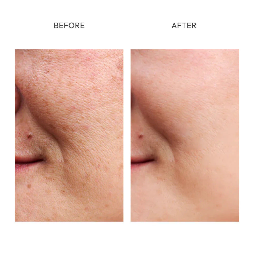 Hoygi Dark Spot Corrector | Feel Beautiful in Your Own Skin Again