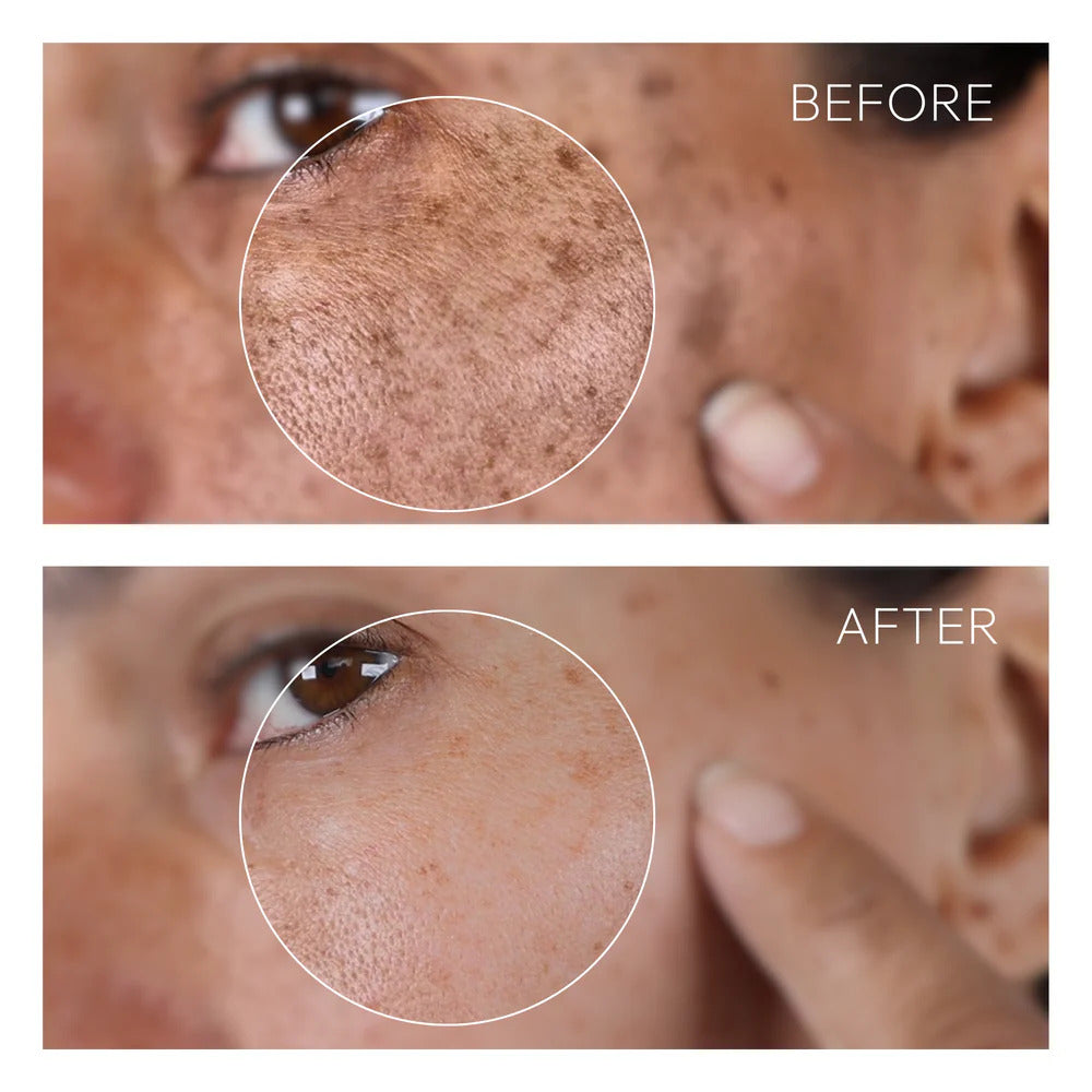 Hoygi Dark Spot Corrector | Feel Beautiful in Your Own Skin Again
