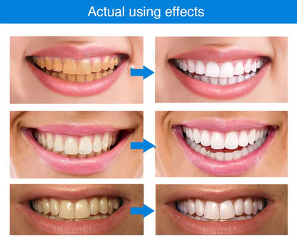 Lotus Blue Spring Teeth Whitening Pen and Gel